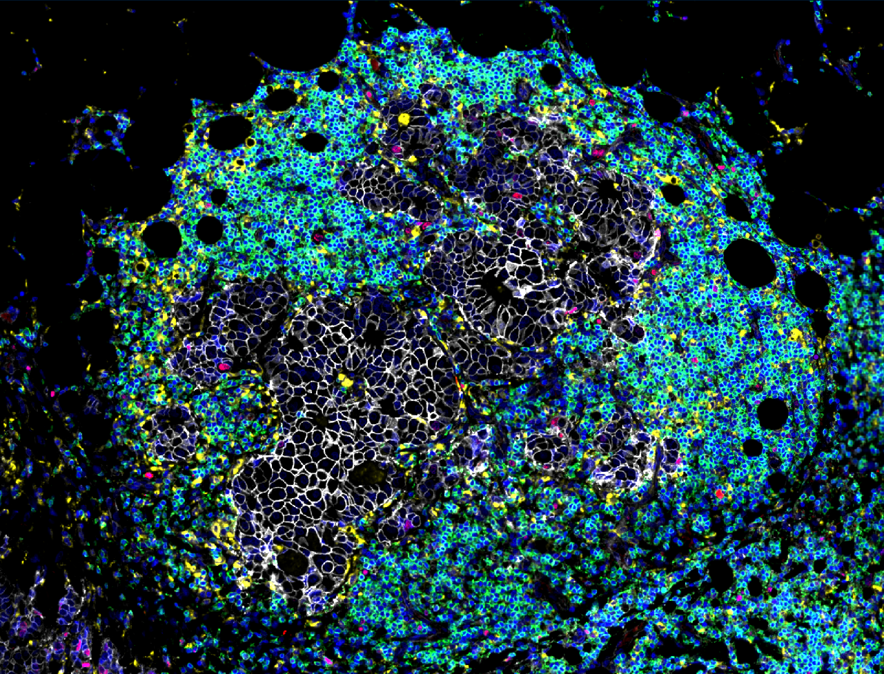 Multiplex immunofluorescence image of breast adenocarcinoma tissue stained with Revolune Illuminate-P4-R (DAPI-blue, Ki67-red, ATP1A1-white, CD68-yellow, CD3-green)
