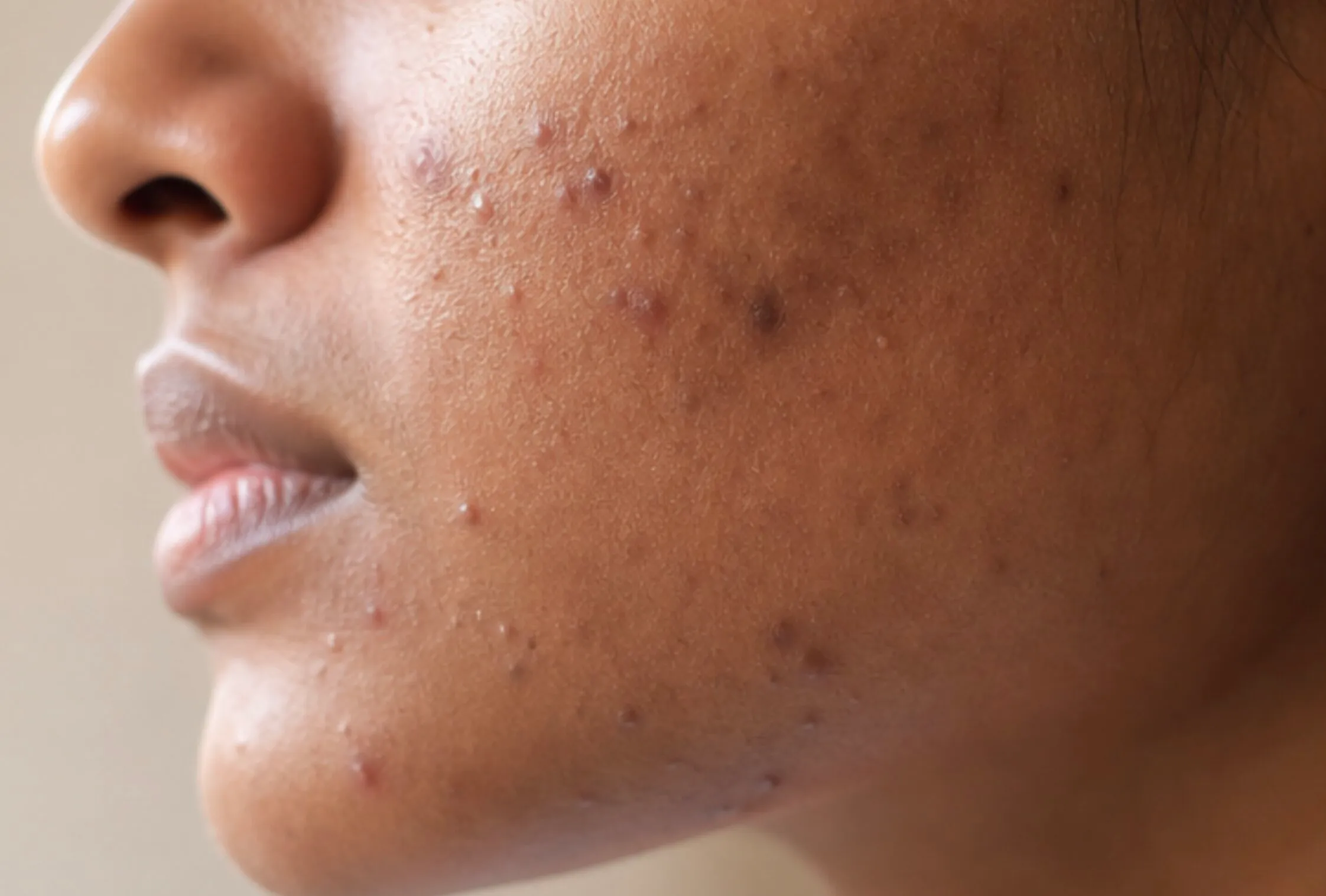 Close-up of a person's cheek and jaw with visible acne and skin blemishes.