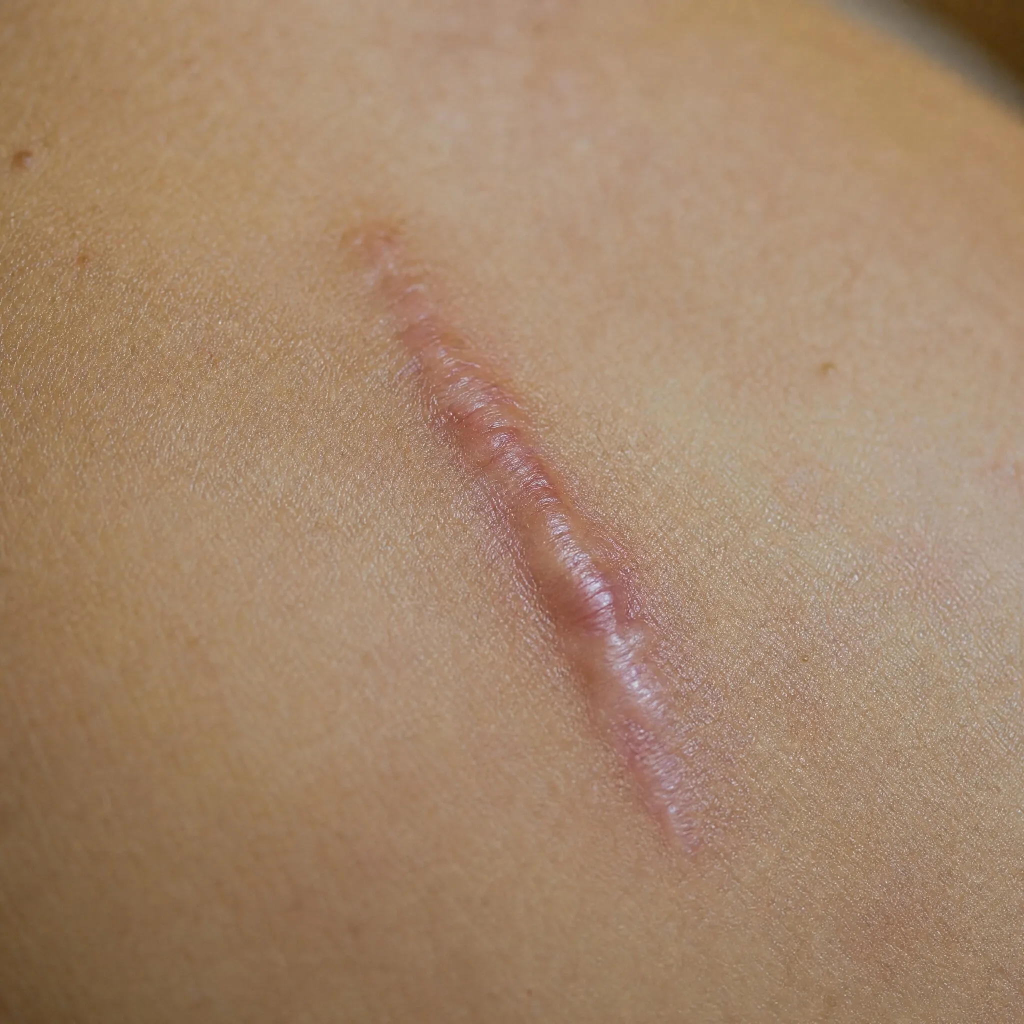 Close-up of a raised, pink scar on tan skin.