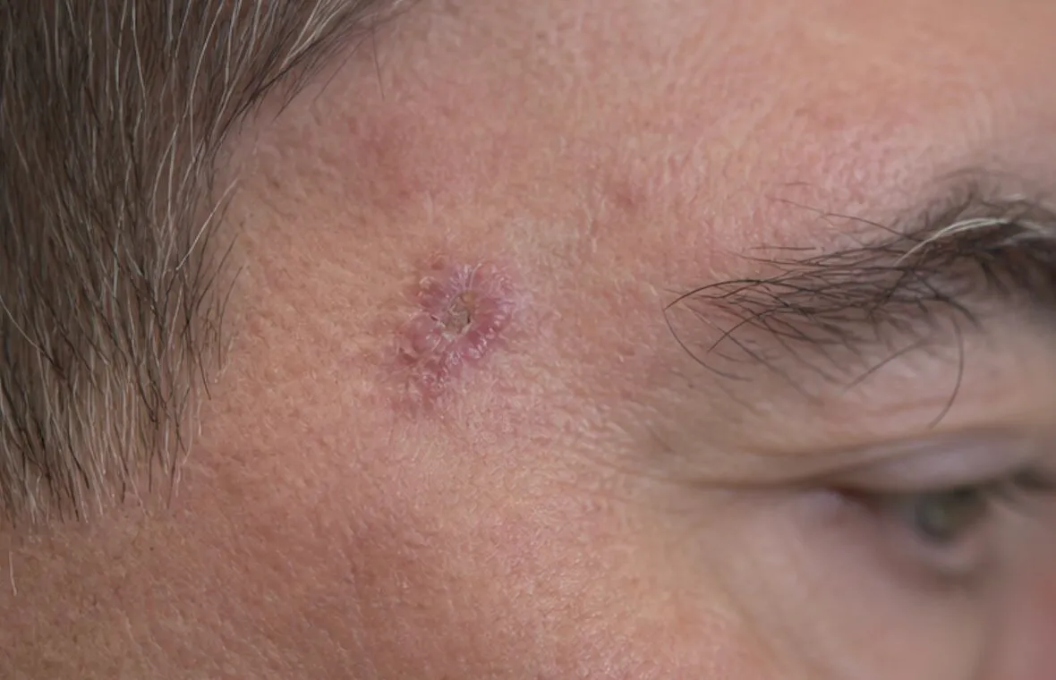 Close-up of a person's forehead with a pink, scaly, and raised skin lesion near the eyebrow.