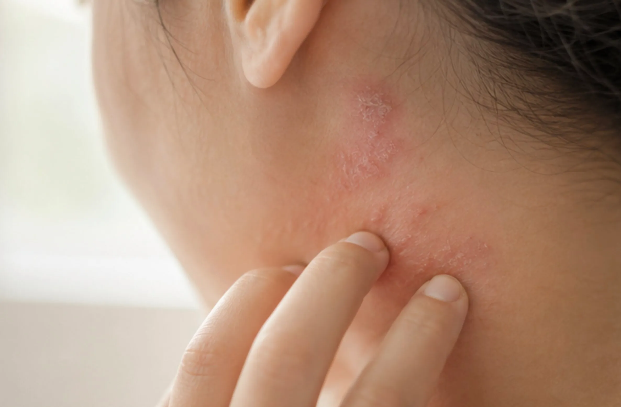 Person scratching red, irritated, dry skin rash on the neck below the ear.