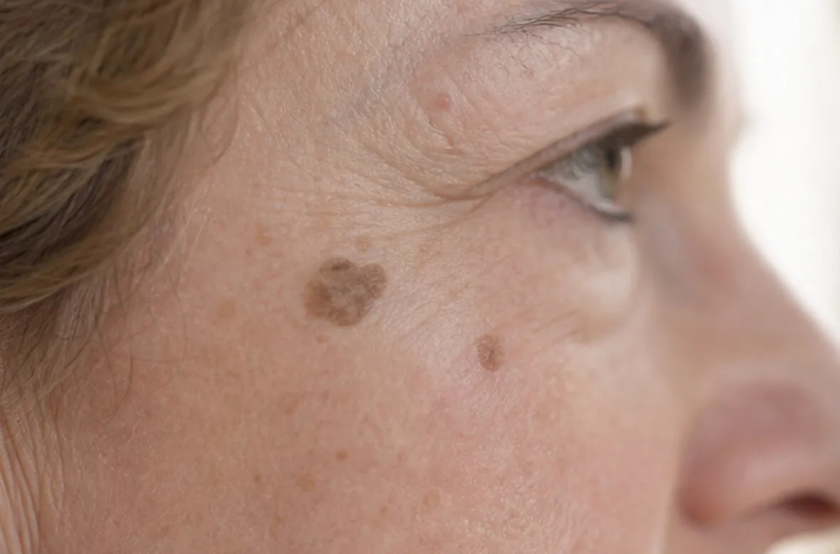 Close-up of a face with two distinct brown skin growths near the cheek and eye.