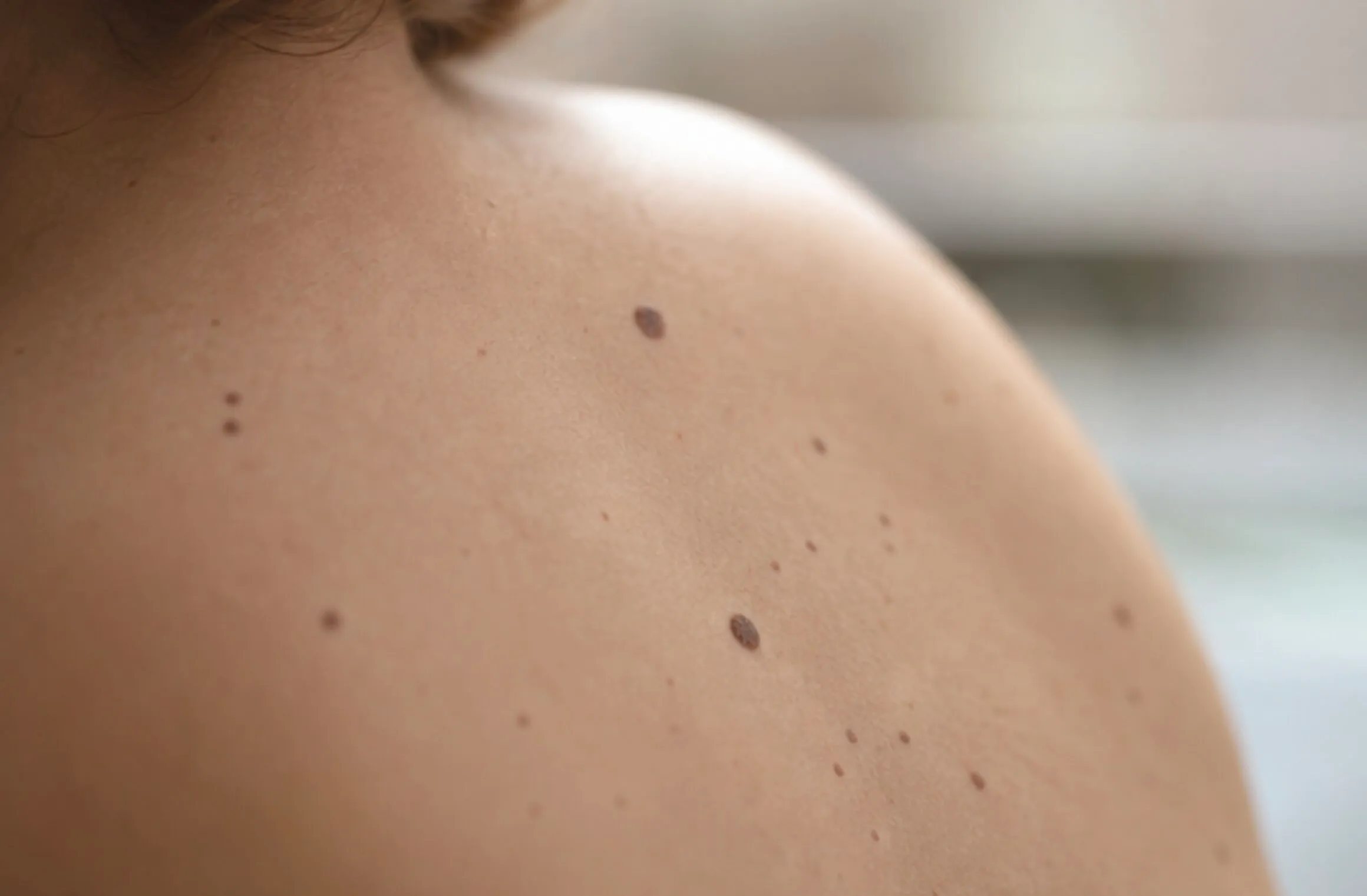Close-up of a bare shoulder with multiple dark moles on light skin.