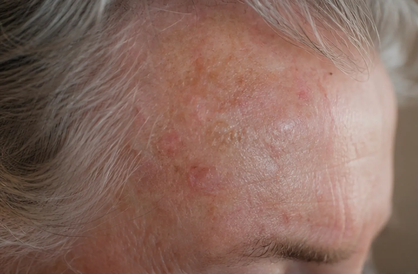 Close-up of a man's forehead with visible skin irritation, redness, and bumps near gray hair.