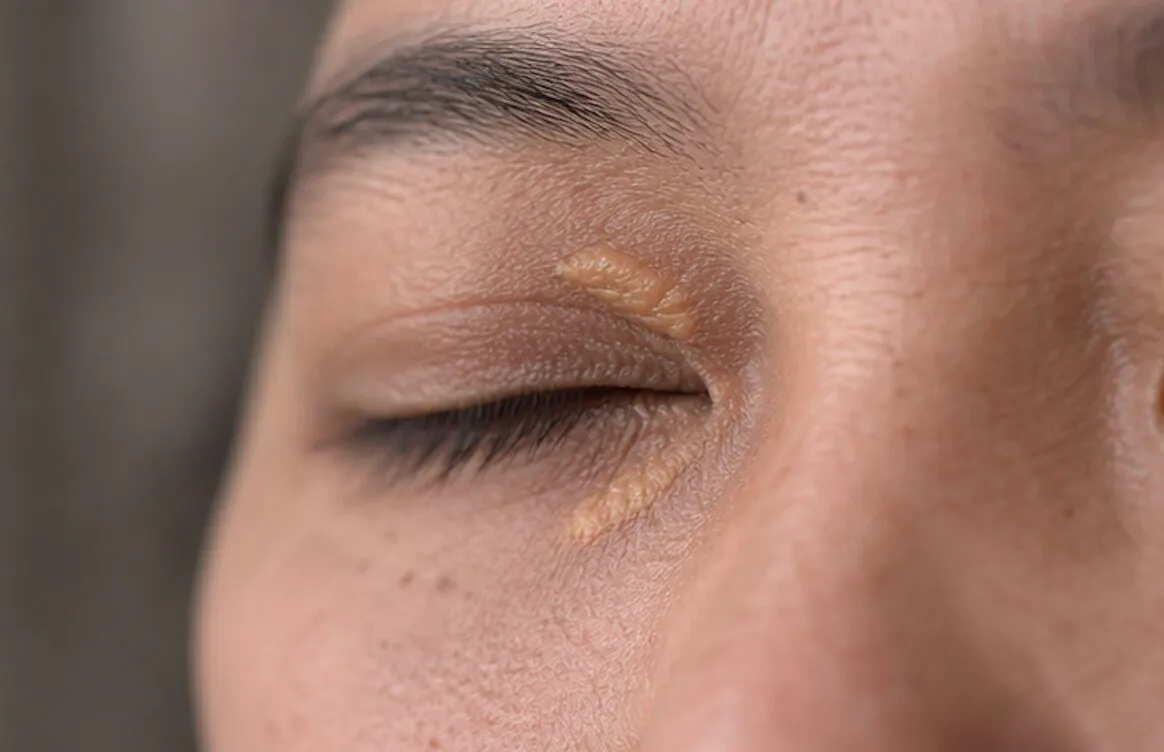 Close-up of a closed eye with yellow cholesterol deposits on the eyelid skin.