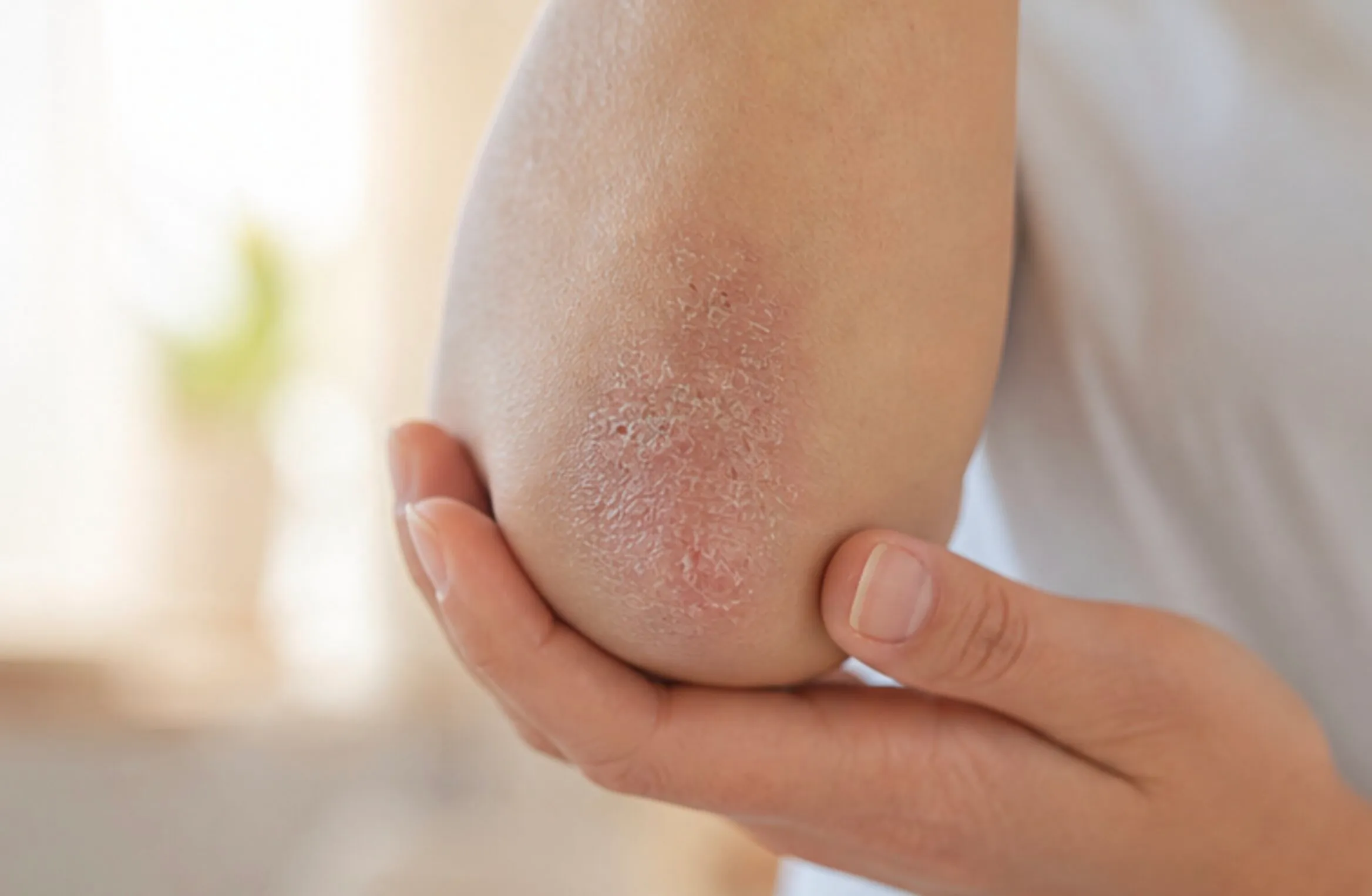 Close-up of dry, flaky red skin on an elbow with a hand gently holding it.