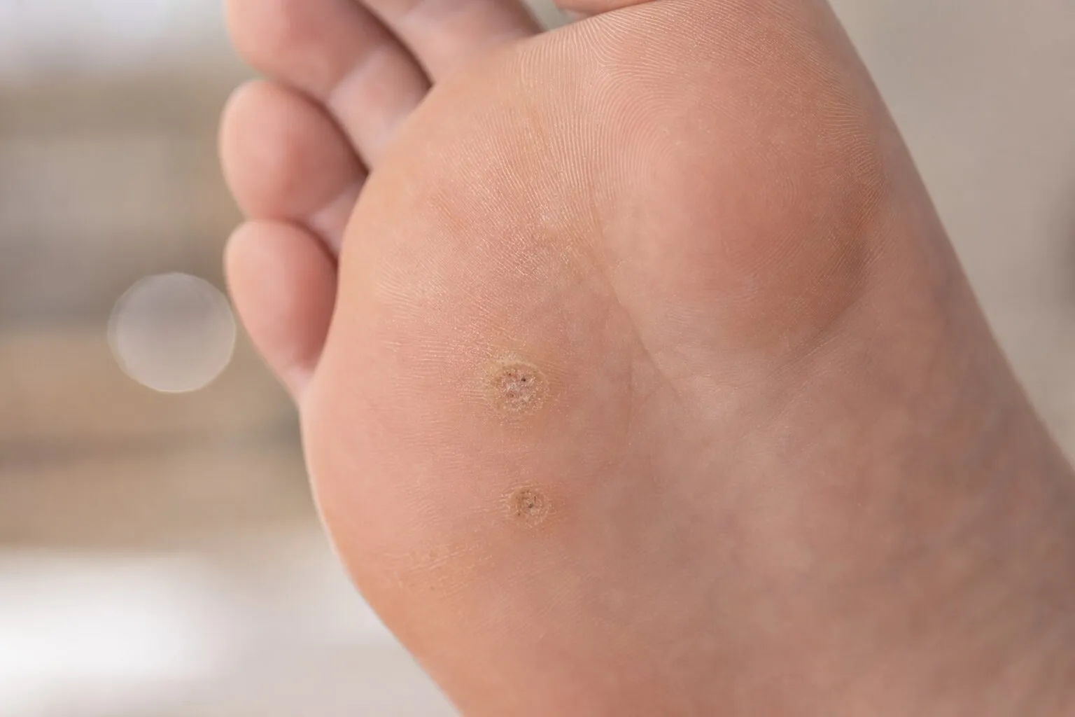 Close-up of foot sole showing two small circular skin lesions, possibly plantar warts.