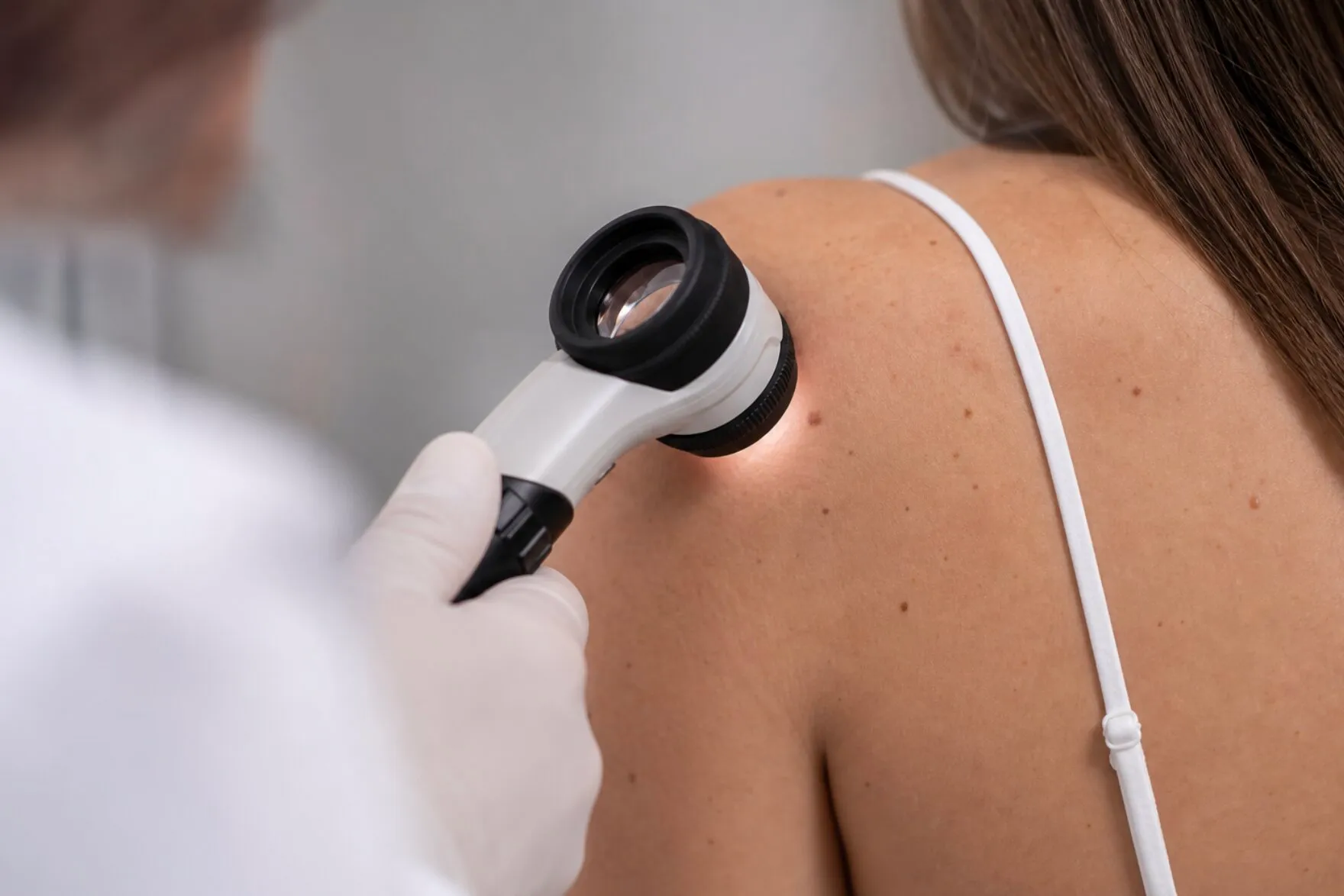 Doctor wearing gloves examining a mole on a woman's shoulder with a dermatoscope.