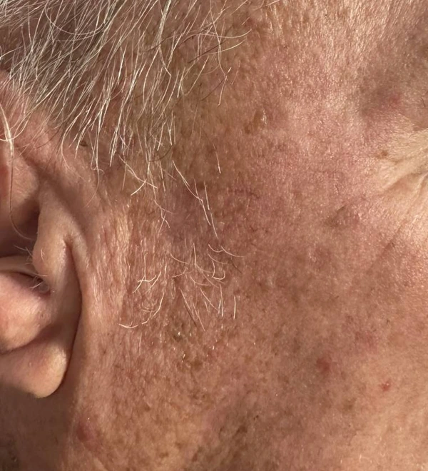 Samme kind og tinding efter fjernelse af gevækster hos Odense Hudlægeklinik.