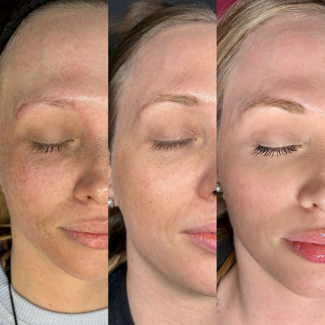 Advanced Laser Treatments Maitland FL