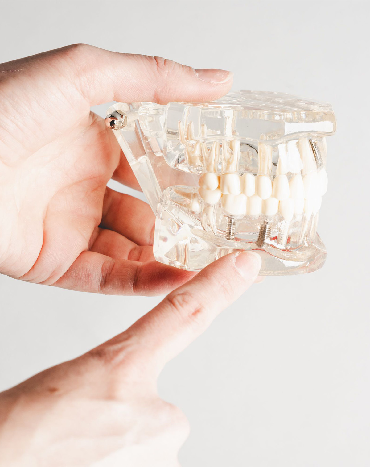 Hand holding a clear dental model showing teeth, roots, and implants with a finger pointing at it.