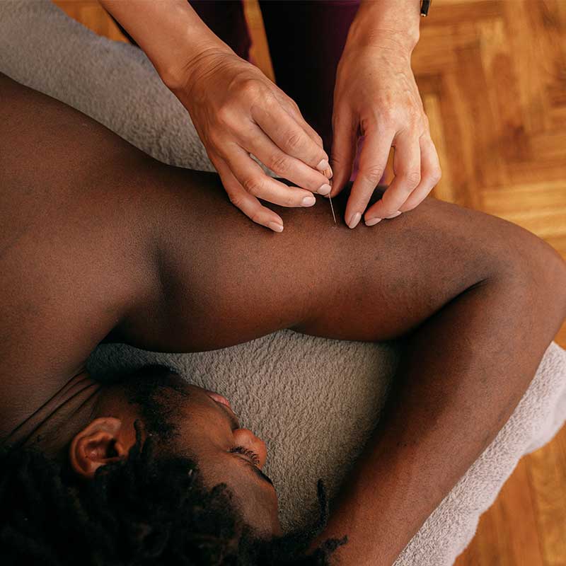 Close-up of hands inserting an acupuncture needle into a man's upper arm on a massage table.