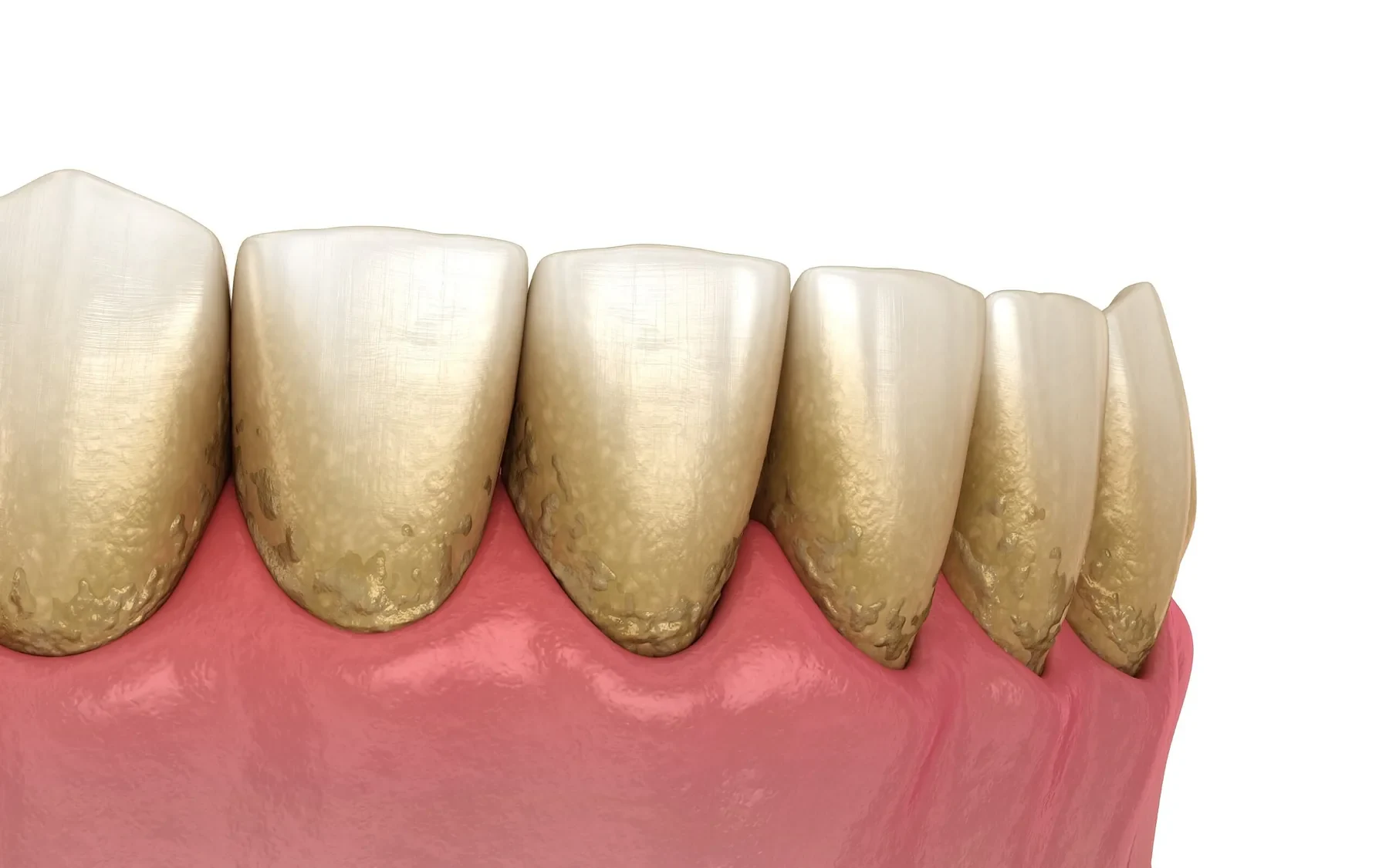 Illustration of plaque and tartar buildup along the gumline