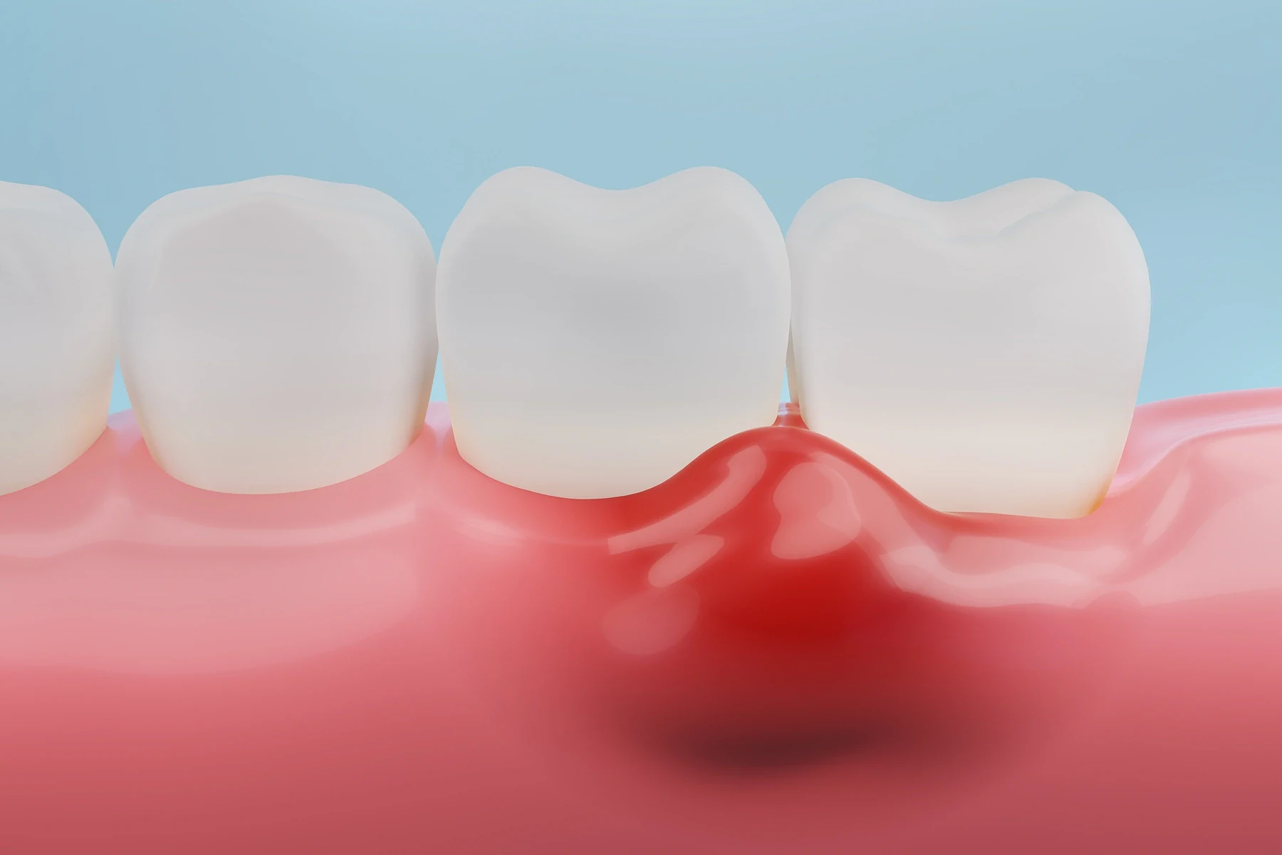 Illustration of swollen, inflamed gum tissue around a tooth