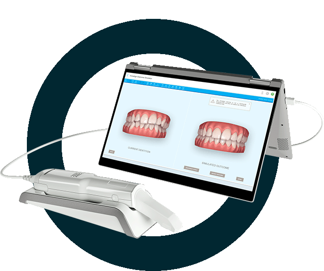 Digital dental scanner connected to a laptop displaying 3D models comparing current dentition and simulated outcome.