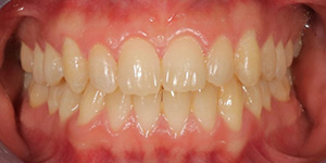 Close-up of teeth with slight crowding and overlapping on the lower front teeth.