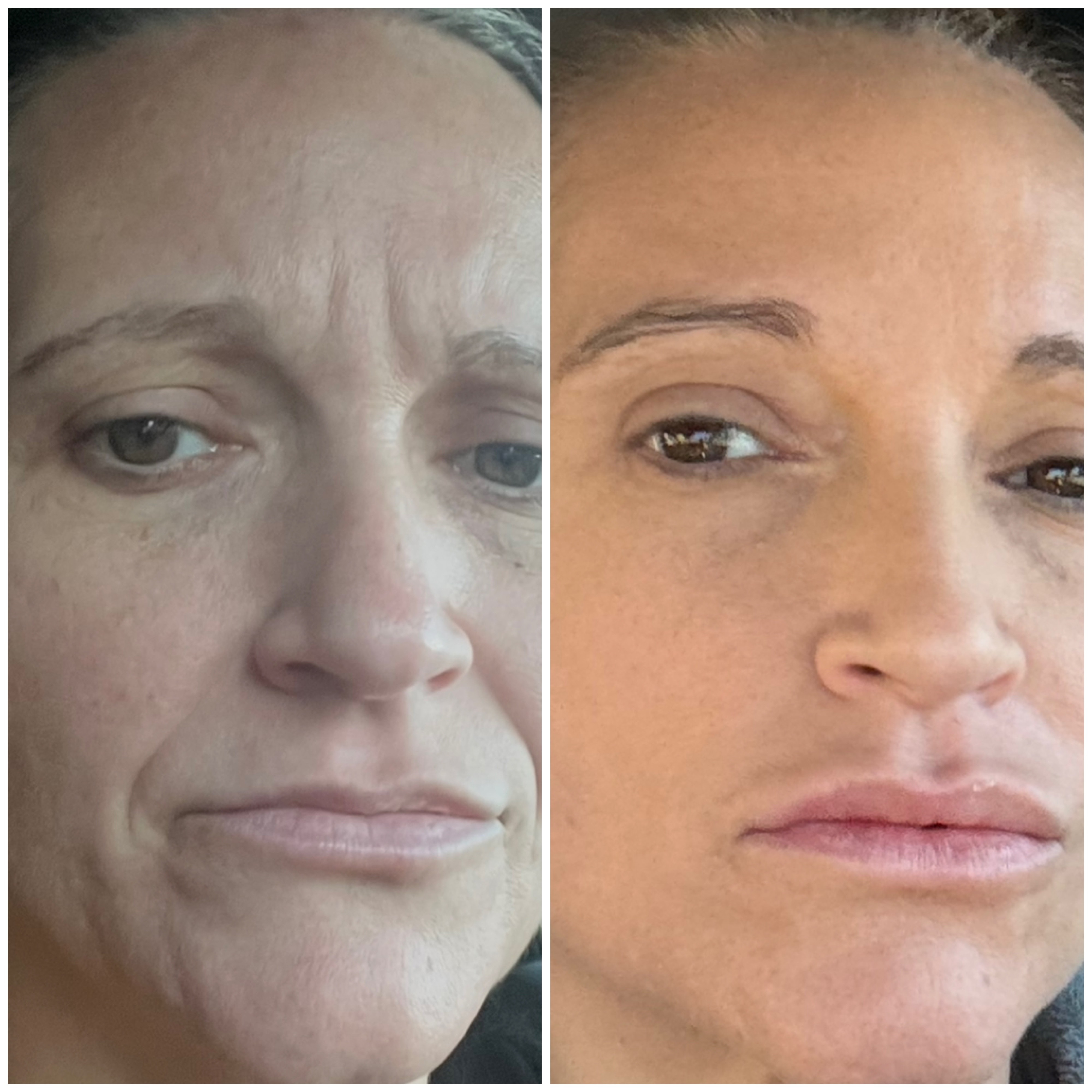 Side-by-side close-up of a woman's face showing reduced forehead wrinkles in the second image.