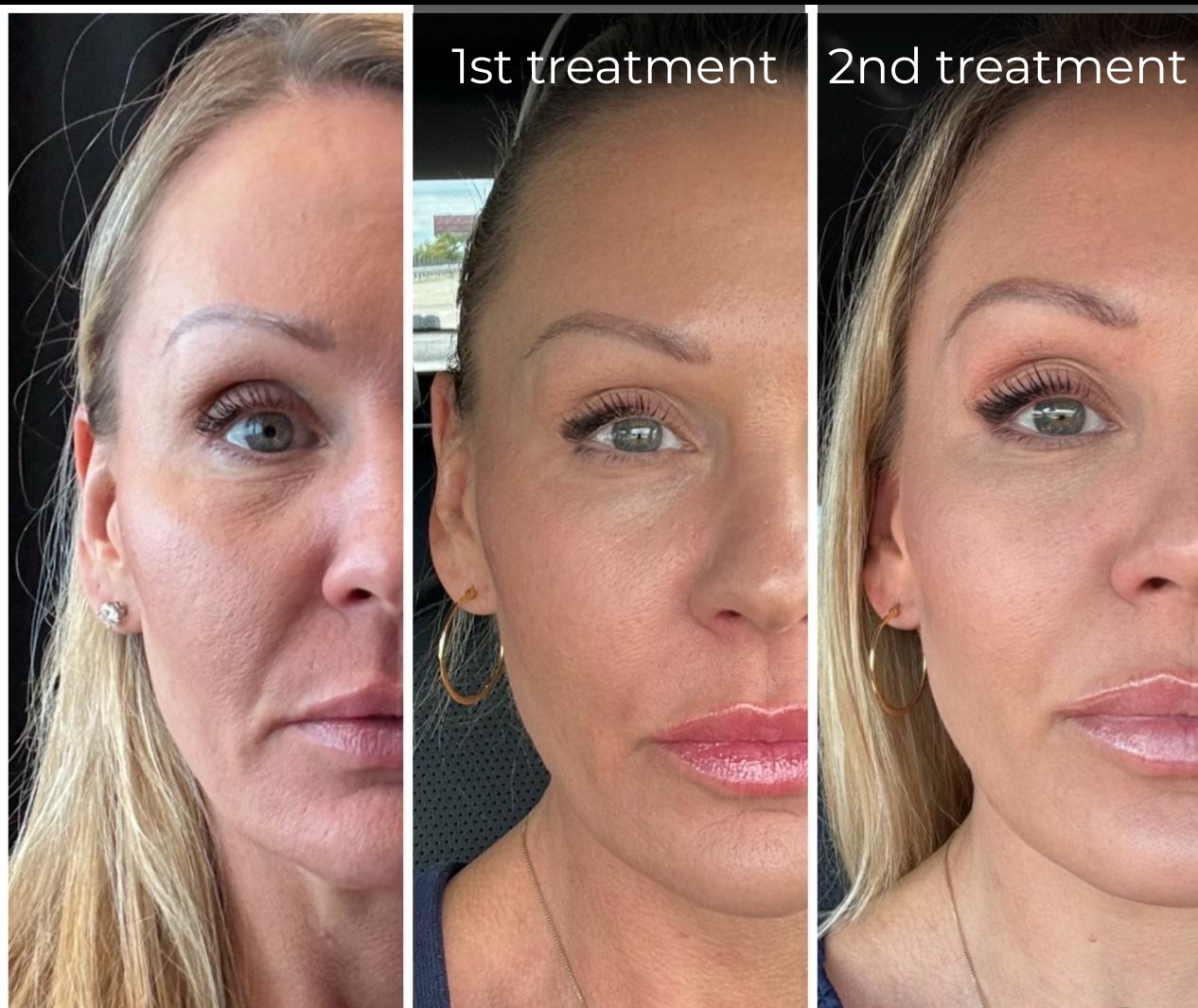 Three close-up side-by-side photos of a woman's face showing skin improvement after 1st and 2nd treatments.