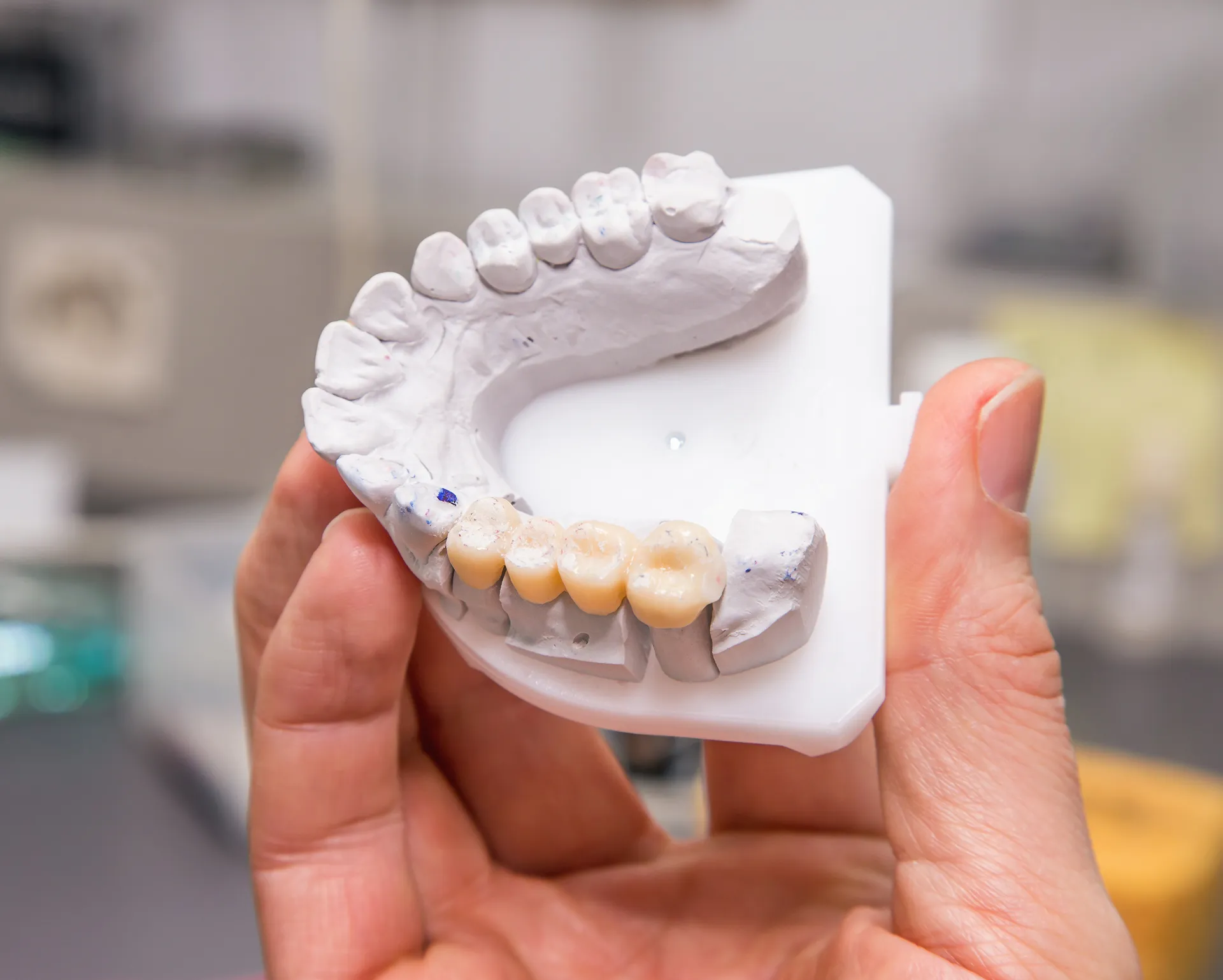 Hand holding a dental mould showing crowns fitted on the lower teeth