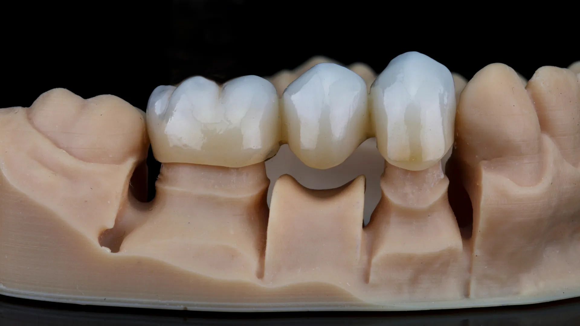 Close-up of a dental model showing a bridge replacing a missing tooth