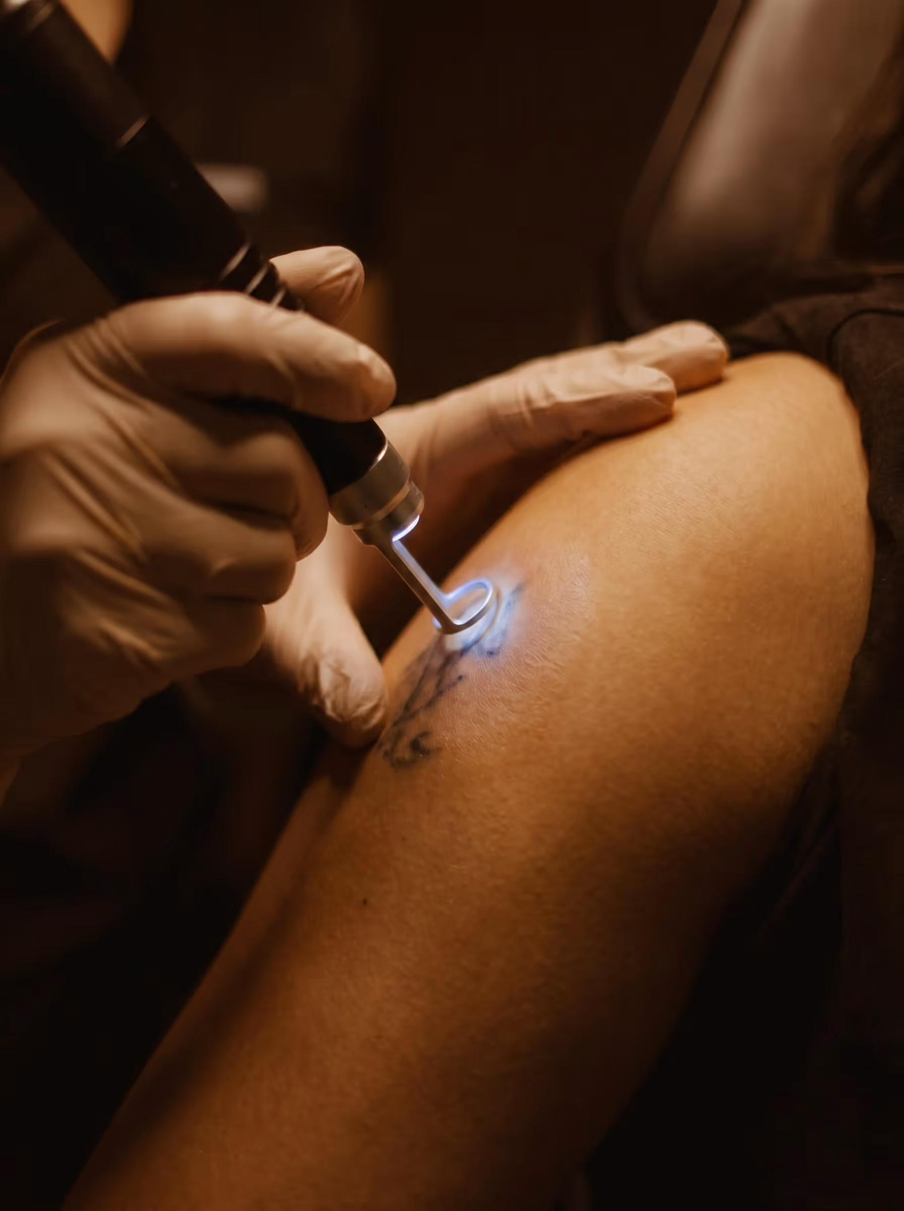 Nahaufnahme einer Tätowierung, die mit einem Lasergerät zur Entfernung behandelt wird.