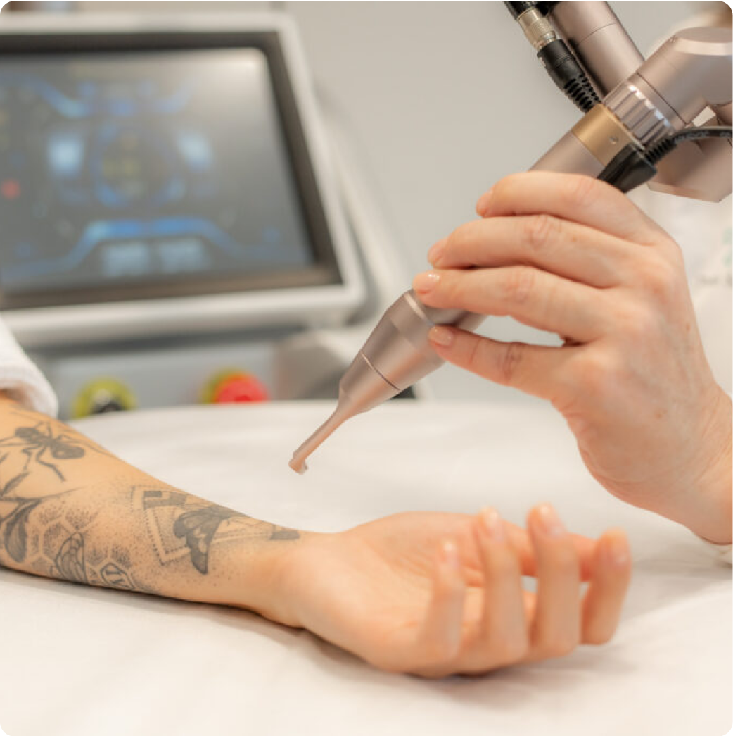 Lasergerät wird auf einen tätowierten Unterarm zur Tattooentfernung gerichtet.