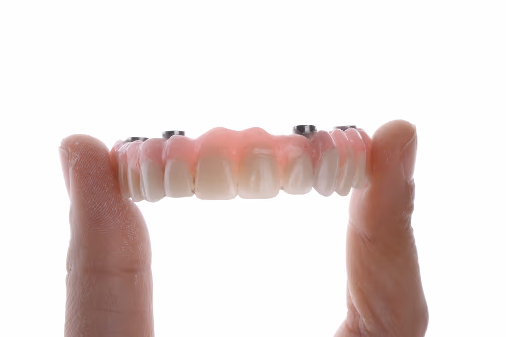 Full-arch All-on-X dental implant restoration model