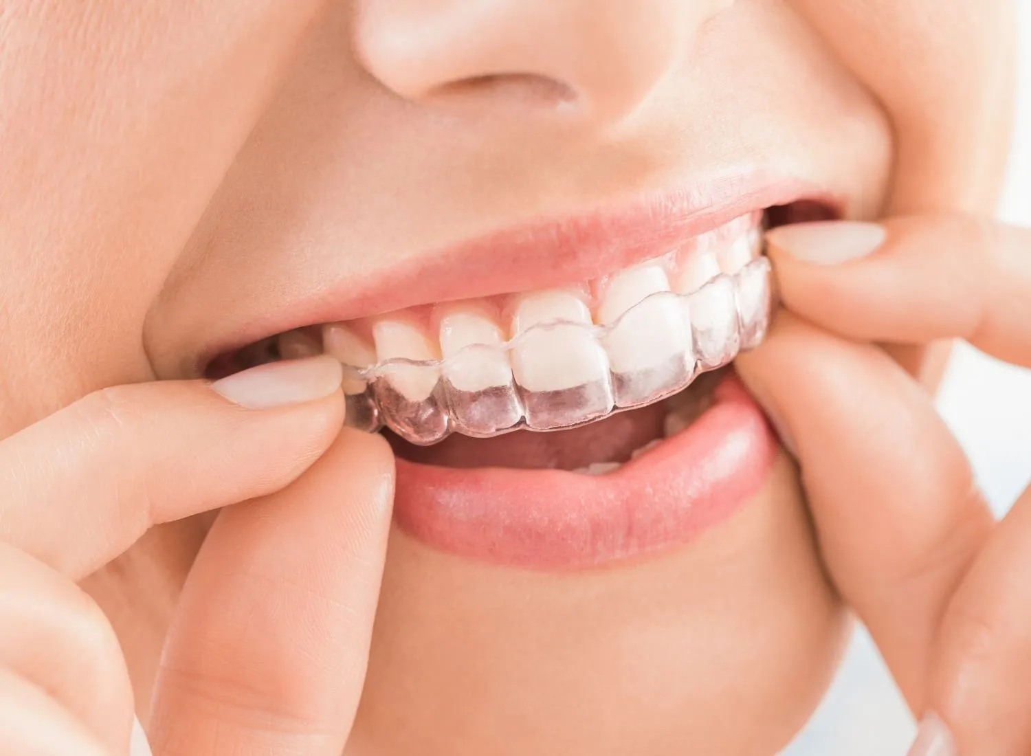 Close-up of hands fitting a clear dental night guard over upper teeth.