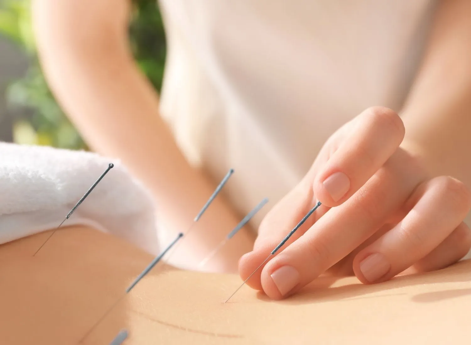 Close-up of acupuncture needles inserted in skin with hand placing one needle during treatment.