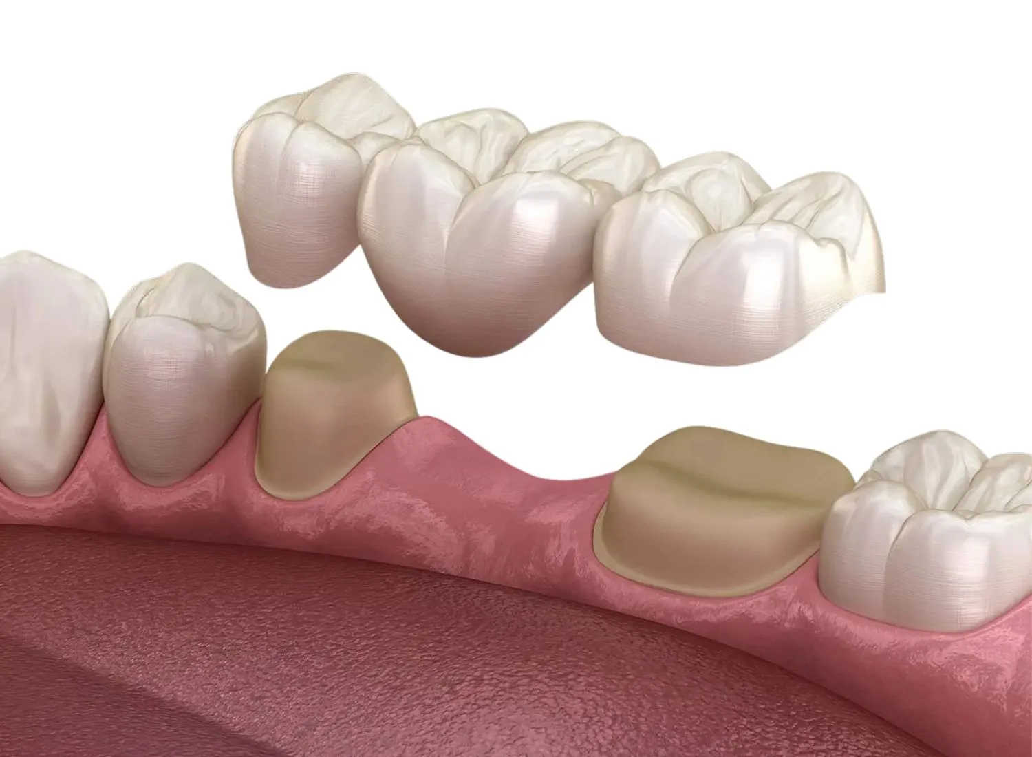 Digital illustration of a dental bridge procedure showing two prepared teeth on the gum with a three-unit dental bridge above ready to be placed covering the prepared teeth and replacing a missing tooth in between.