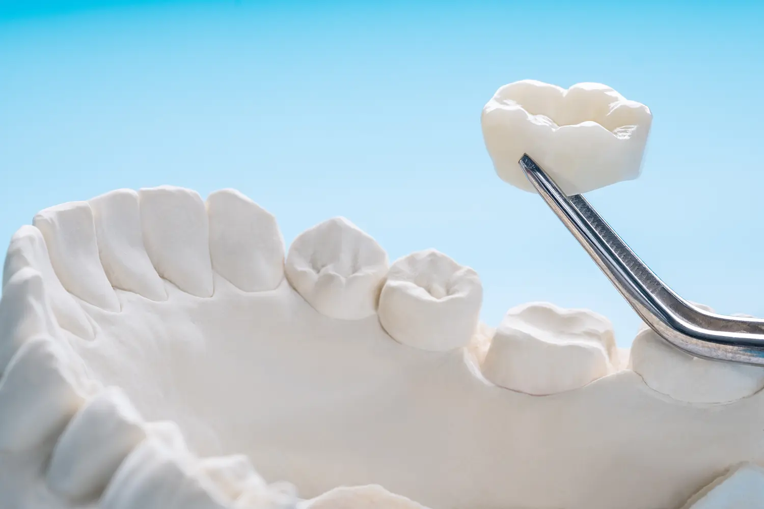 Close-up of a dental model of lower jaw with a dental crown being held by tweezers above a tooth.