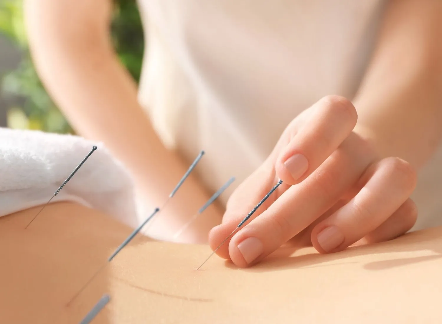 Close-up of a person receiving acupuncture treatment with thin needles inserted into their back skin, and a practitioner's hand gently adjusting one needle.