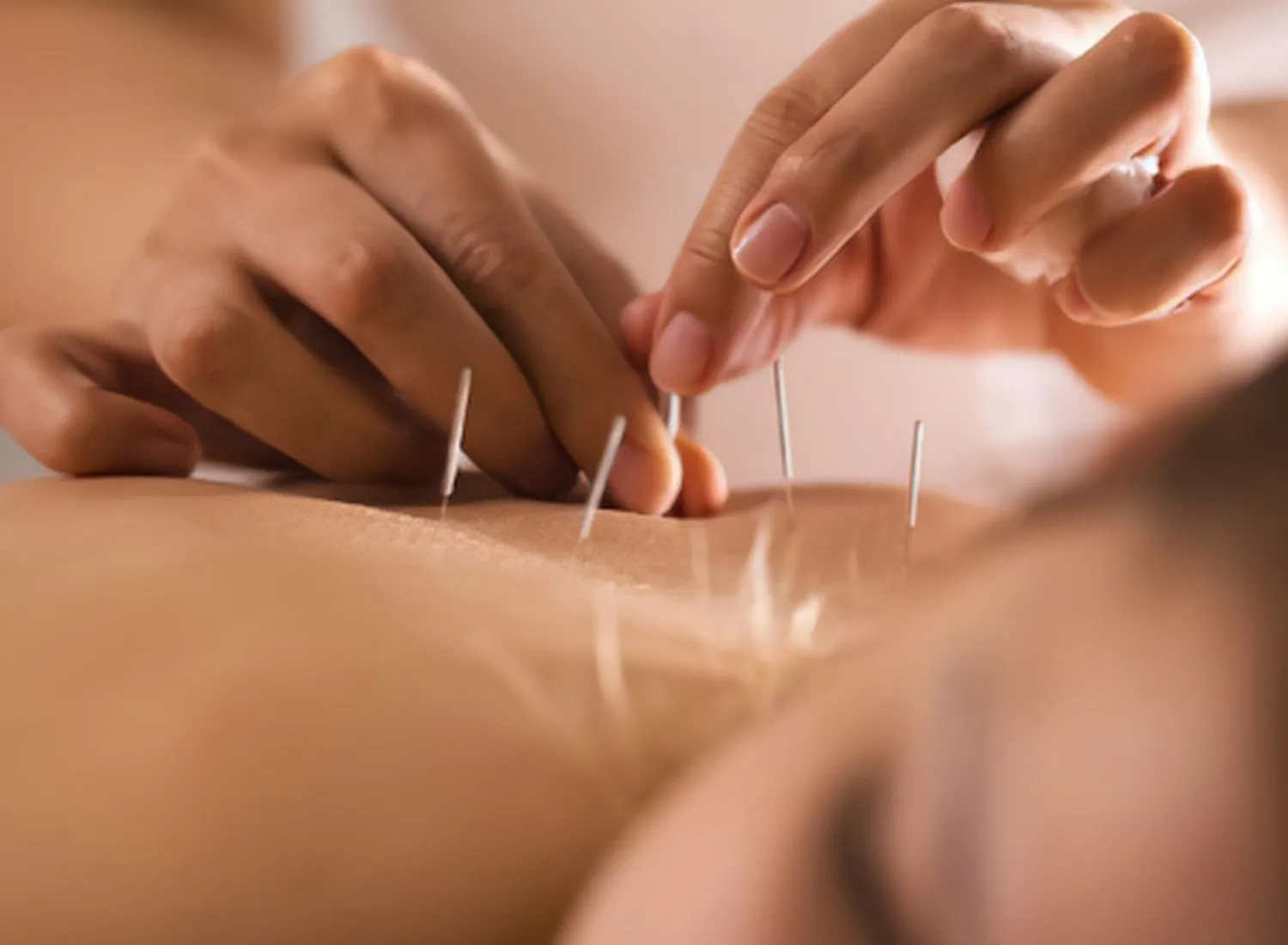 Close-up of hands inserting thin acupuncture needles into a person's back during a treatment session.