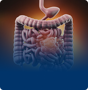 Dysbiosis (Microbiome Disturbance)