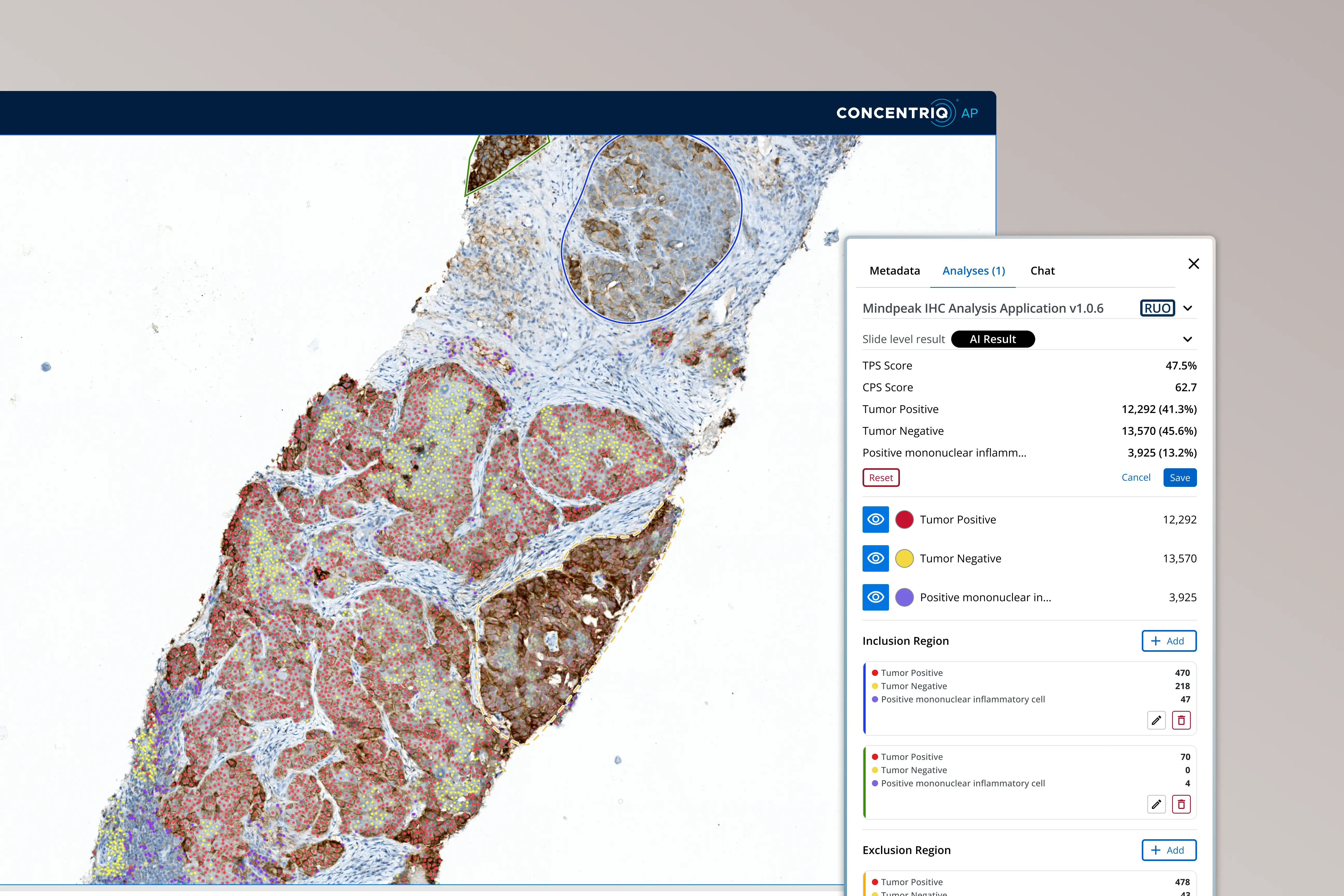 Histology tissue scan with AI analysis showing tumor positive, tumor negative, and inflammatory cells.