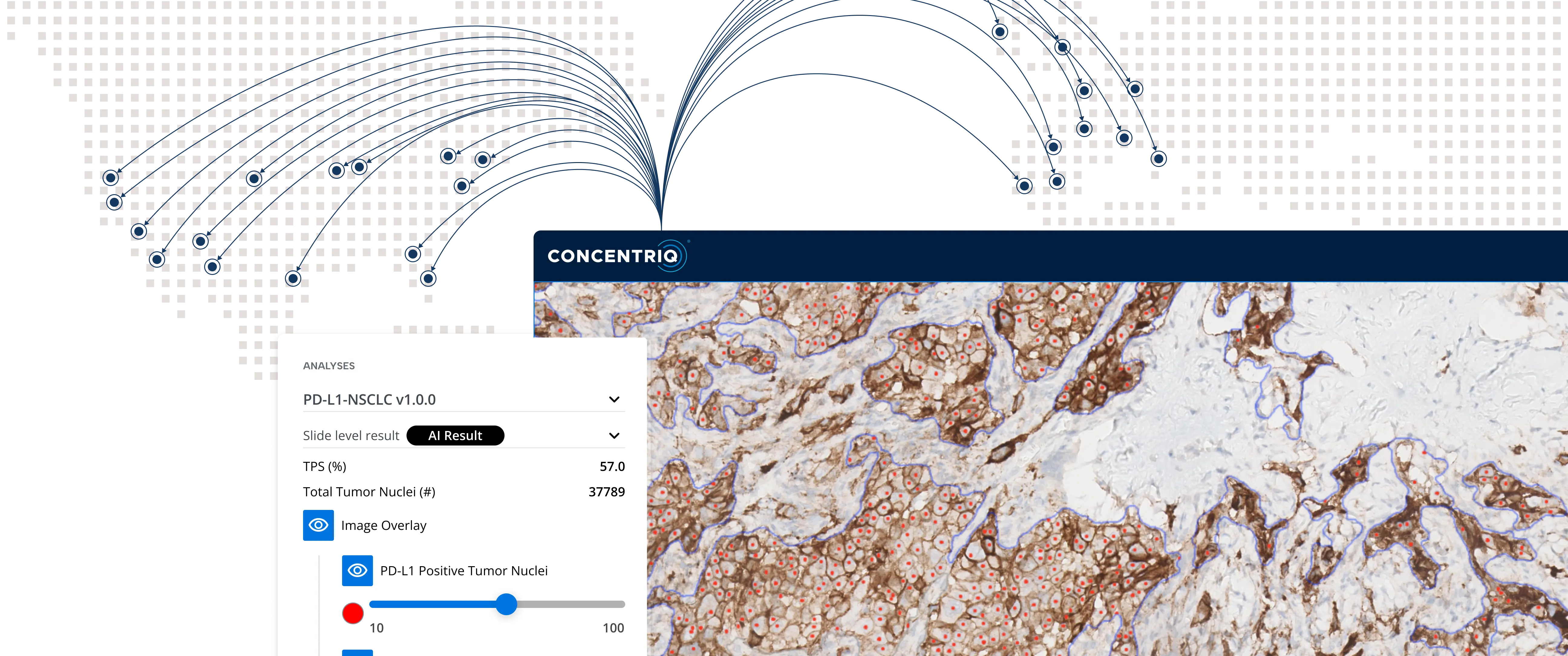 User interface screen showing PD-L1-NSCLC tumor analysis with image overlay of highlighted tumor nuclei.