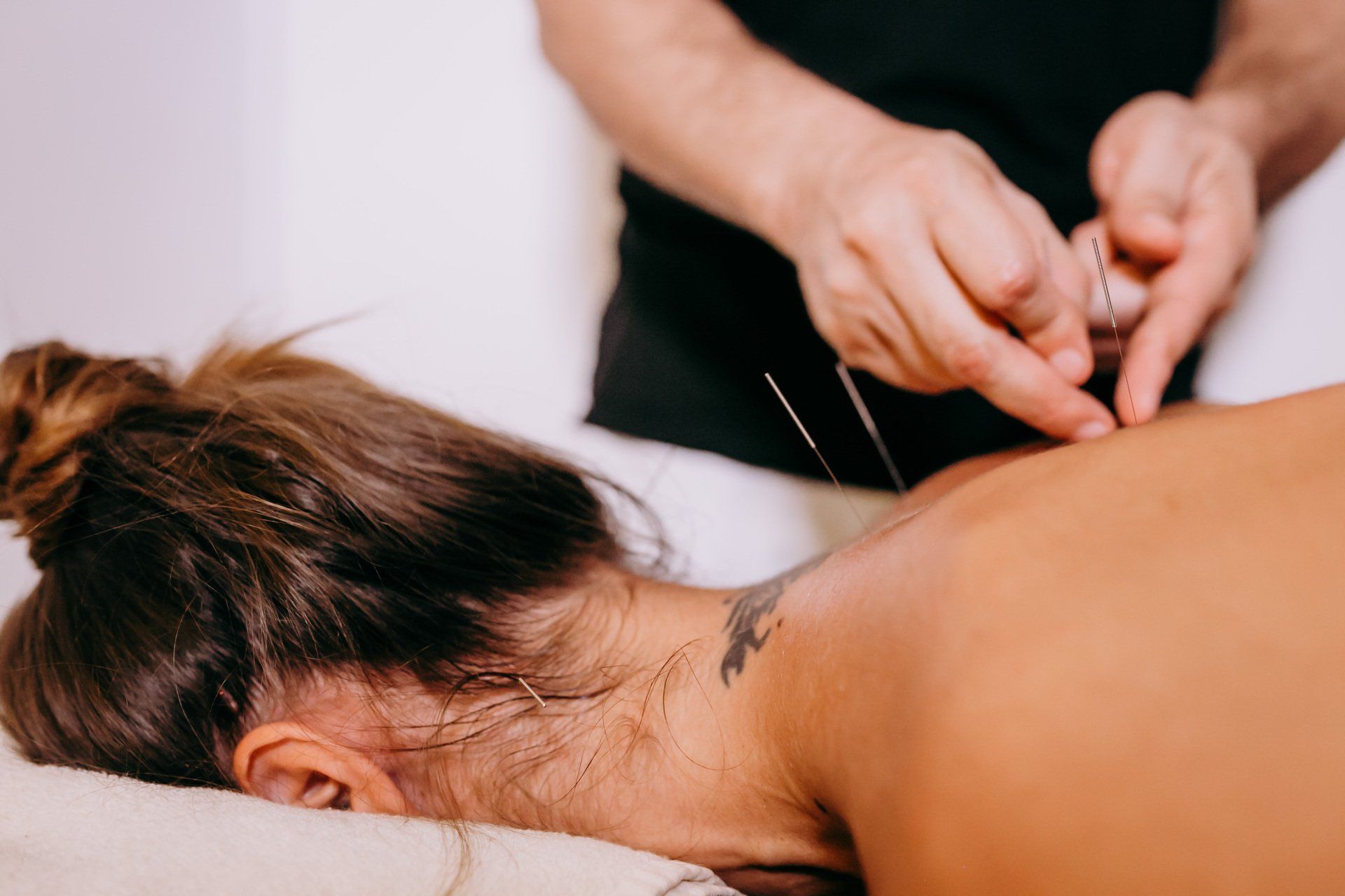 Featured image for Benefits of Dry Needling