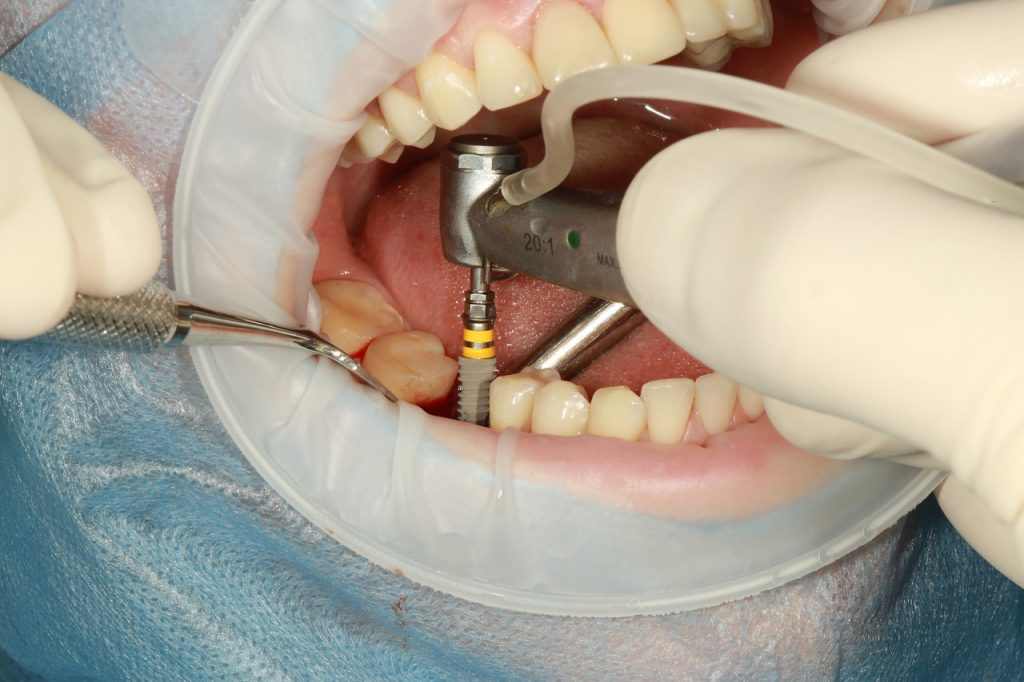Dental Implant Courses