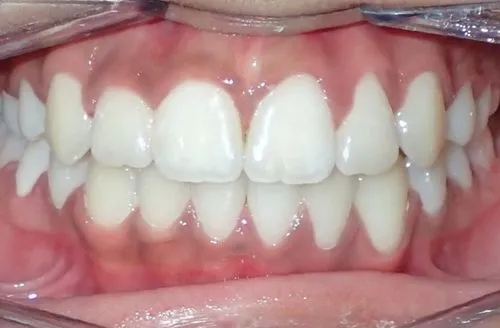 Close-up of clean, straight upper and lower teeth with healthy gums.