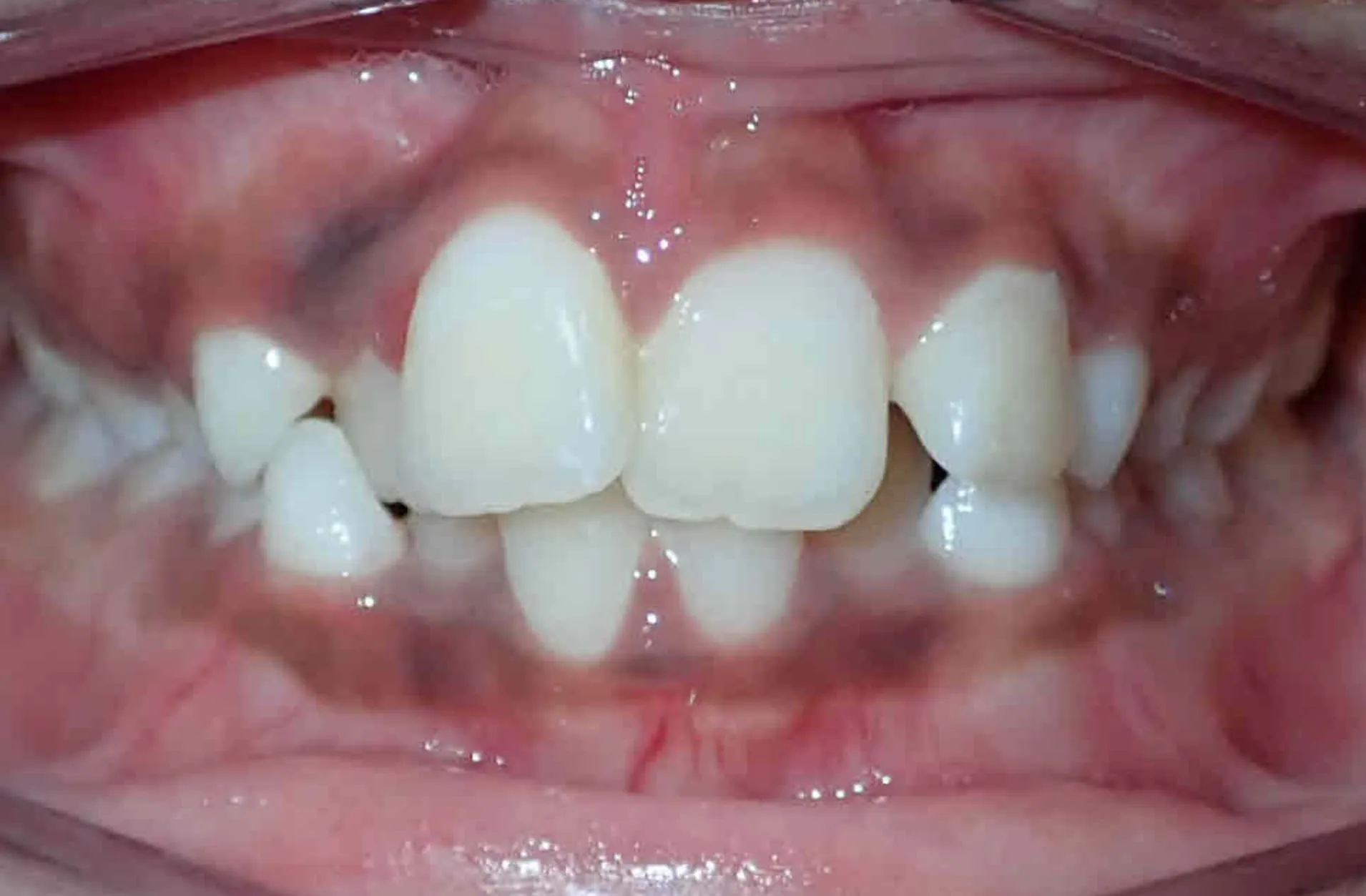 Close-up of upper teeth showing crowded and misaligned front teeth with gaps and overlaps.
