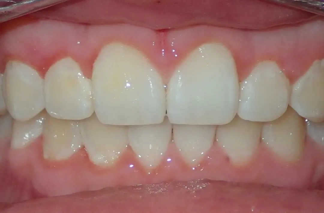 Close-up of upper and lower front teeth with slight gaps and pink gums visible.