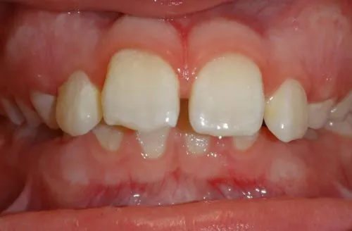 Close-up of gums and teeth with visible gaps and misalignment between upper front teeth.