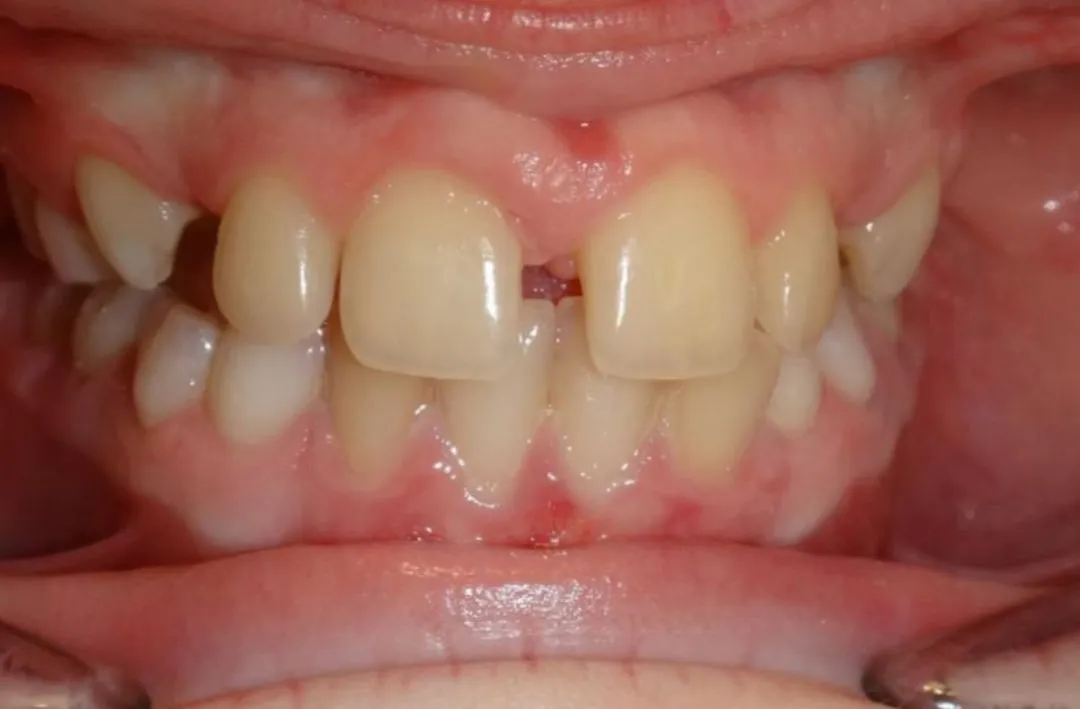 Close-up of teeth with gaps, visible uneven spacing and slightly swollen gums.