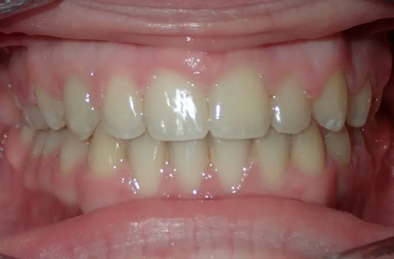 Close-up of a person's mouth showing upper and lower teeth with healthy gums.