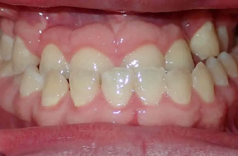 Close-up of misaligned upper and lower front teeth with visible gaps and crowding.