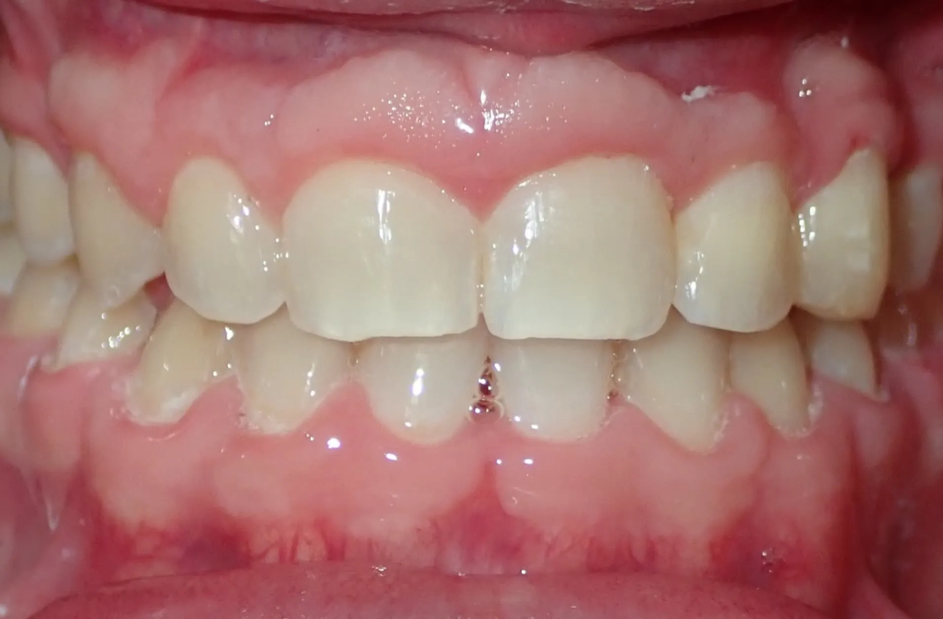 Close-up of upper and lower teeth with healthy pink gums and slight gap between front teeth.