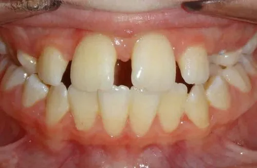 Close-up of upper and lower teeth showing gaps and slight misalignment.