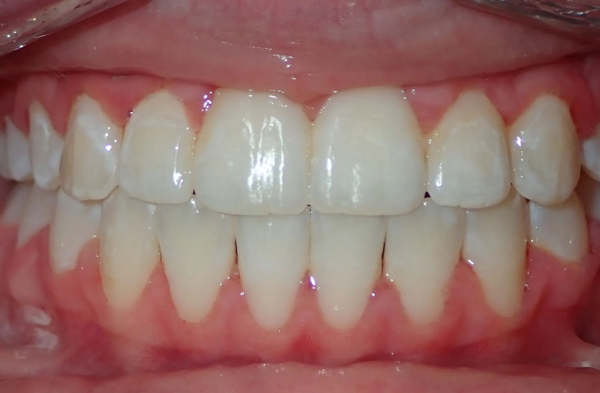 Close-up of clean upper and lower front teeth with healthy pink gums.