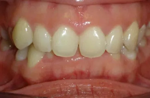 Close-up of teeth with noticeable crowding and overlapping front teeth.