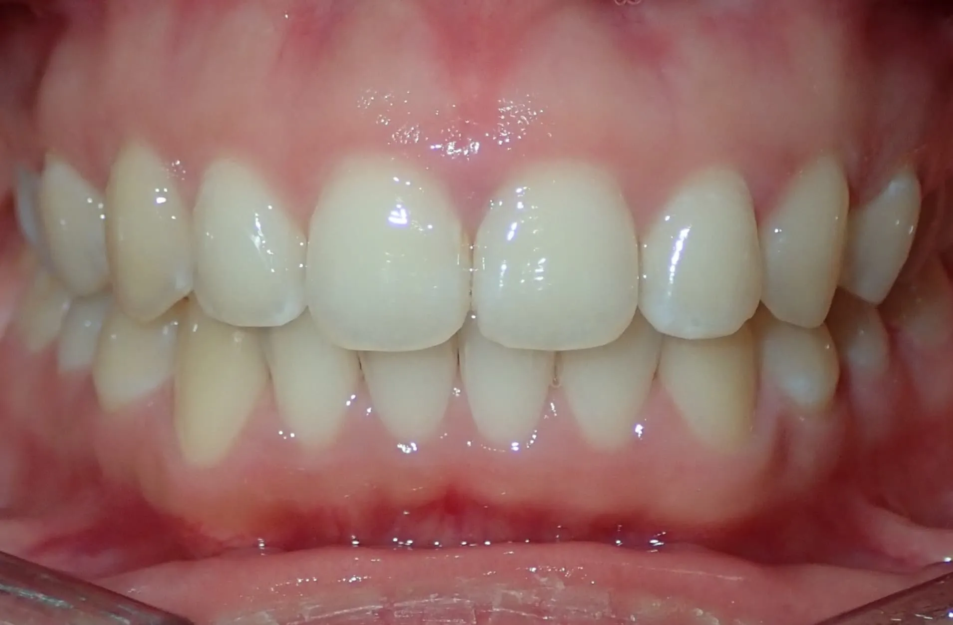 Close-up of healthy upper and lower teeth with pink gums and slight natural color variation.
